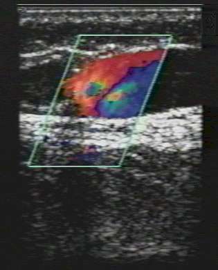 Color duplex ultrasound. 