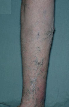 Varicose veins are a visible sign of increased pressure inside the leg veins. 
